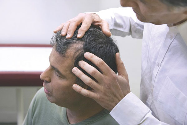 Alopecia androgenética
